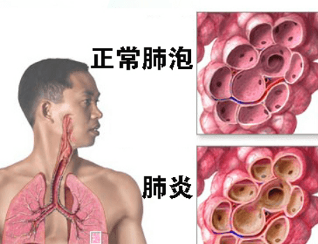 肺炎